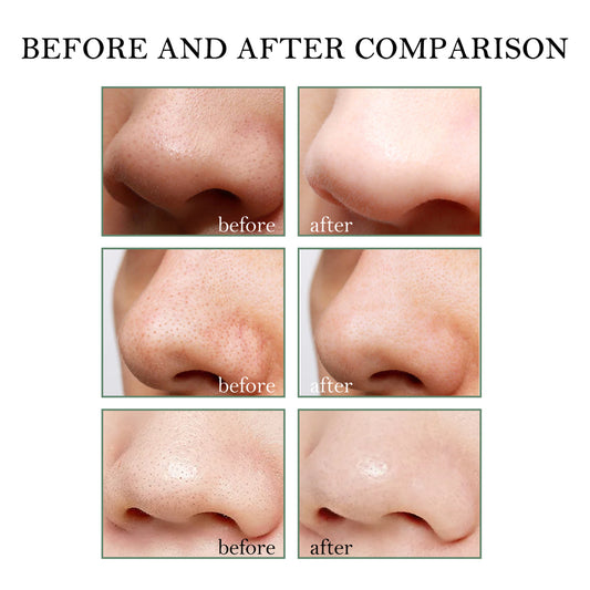Blackhead Remover Kit – Deep Cleansing Cream (15g) + 40 Pore Strips for Blackheads & Clear Skin