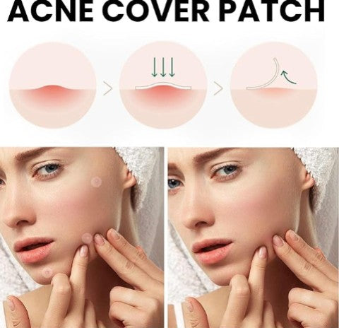 Acne Cover Patch- Hydrocolloid Acne Cover for Fast Healing, Invisible & Anti-Scar
