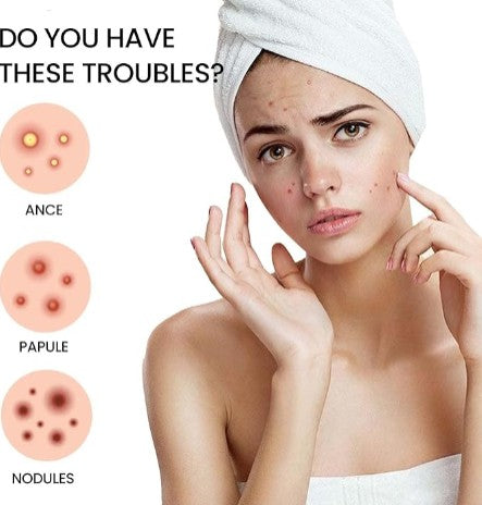 Acne Cover Patch- Hydrocolloid Acne Cover for Fast Healing, Invisible & Anti-Scar